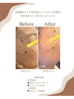 エステサルビア/フェイシャル　ビフォーアフター