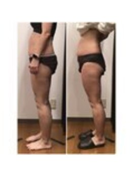 ユメカ 日の出院(YUMEKA)/お腹・脚のラジオ波施術