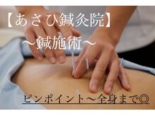 あさひ接骨院 鍼灸院の雰囲気（鍼施術のご希望もお任せください！ピンポイント～全身まで◎）