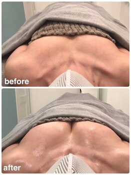 美人バスト 赤羽店/【バストアップ症例】