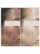 ベルタ(BELTA)/ケア前→12ヶ月後　ニキビ