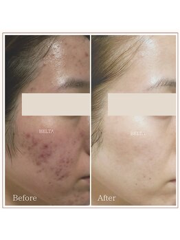 ベルタ(BELTA)/ケア前→12ヶ月後　ニキビ