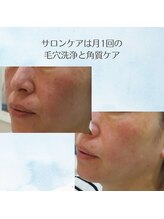 マリー エクラン/Drリセラのホームケア2年使用