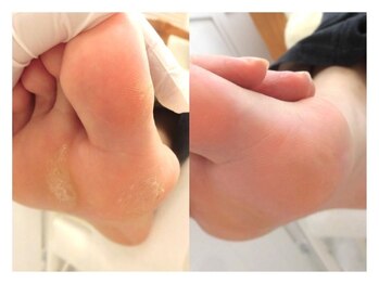 巻き爪ケアサポート ルアナ(LUANA)/Before→After