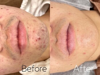 バーニー 梅田店(BARNEY)/ヒゲ脱毛　/脱毛/顔脱毛