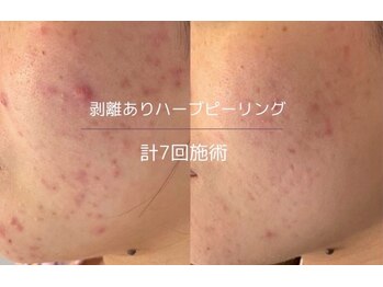 ヒジ(Life Salon)/ハーブピーリング