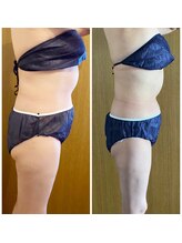 アリス 赤坂/脂肪冷却 洋梨体系無敵の8カップ