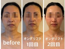 キプラ 香椎駅前店(KIPURA)/オンダ小顔マシン+小顔矯正2回目