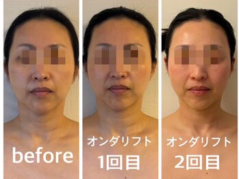 キプラ 香椎駅前店(KIPURA)/オンダ小顔マシン+小顔矯正2回目