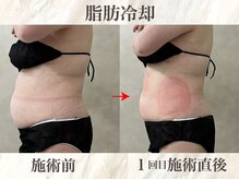 ウィボーテ(We Beaute)の雰囲気（【脂肪分解】脂肪冷却セットで痩身の効果UP♪ダイエット◎）