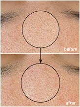 毛穴専科/毛穴洗浄で毛穴汚れゼロ！？