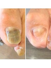 ドクターネイル爪革命 小田原鴨宮店/肥厚爪ケア