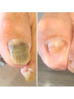 肥厚爪ケア