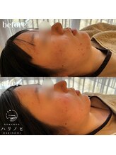 ハリノヒ 本町院/肌荒れ・ニキビケア特化美容鍼