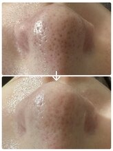 ベラドンナ(Bella Donna)/大人気☆毛穴洗浄