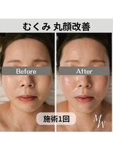 ミピマム 横浜駅前店/小顔矯正 丸顔改善 Before After