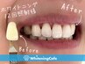 【PR】ホワイトニング/セルフホワイトニング/千葉ホワイトニング