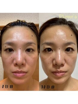 プルメリア(Plumer’a)/エニシーグローパック集中ケア☆