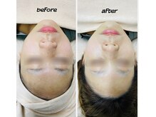 KMB 恵比寿店/毛穴洗浄＋光＋炭酸ガスパック