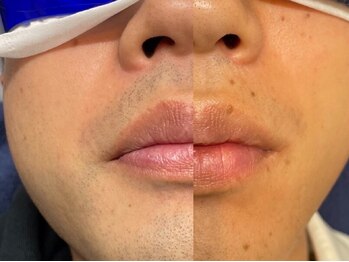 メンズオーシャンブルー/ヒゲ症例1