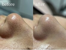 ビビ(Vivi)/毛穴ケア