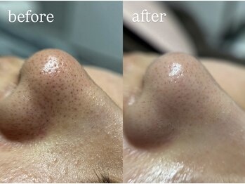 ビビ(Vivi)/毛穴ケア