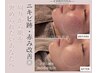 《本気の肌質改善》選べるピーリング3種 カウンセリング＋初回体験