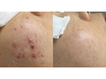 チュチュ(TUTU)/ニキビ