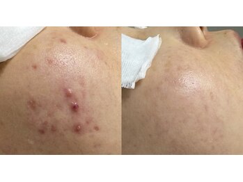 チュチュ(TUTU)/ニキビ