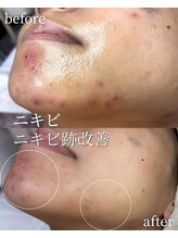 ココリール/ニキビ・ニキビケア