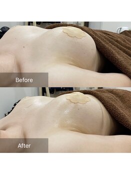 ルミエール(Lumiere)/【倉敷市】バストアップ施術事例