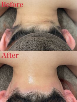 ミース 越谷店/うなじ矯正●Before、After