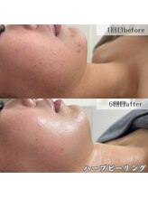 ネイルズビー 別邸(Nail's be)/揺らぎやすい肌も肌質改善