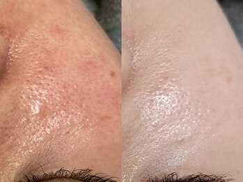 ラシック 加古川店(La chic.)の写真/繰り返す肌荒れや毛穴悩みに終止符。本気の肌質改善で内側から発光するようなツヤ美肌へ