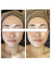 モアナラニ(MoanaLani)/【漢方OHLハーブピーリング】