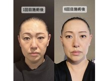 最新美容マシーン【COUSHI リフト】で肌質改善へ！！