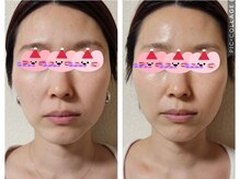 シェノン(Chainon)/セラピールで毛穴も輪郭も変わる