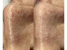 エミリー 守山(EMILY)/【症例写真】毛穴洗浄 (2)