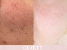 クラルテ(CLARTE)/肌荒れ/くすみ/赤み/毛穴