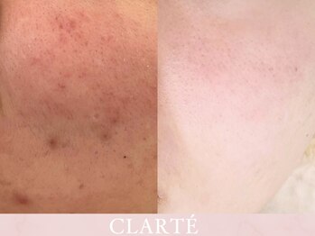 クラルテ(CLARTE)/肌荒れ/くすみ/赤み/毛穴