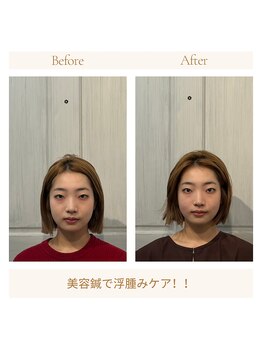 ボージュ(BeauJu)/美容鍼