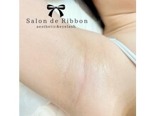 気になる箇所の部分脱毛もOK！