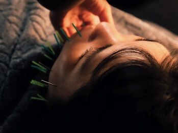 セント 江坂店(SCENT)の写真/江坂駅4分《頭皮から引き上げ最強リフトUP!!》美容鍼+頭皮鍼80分¥8000★疲労改善&肌管理◎