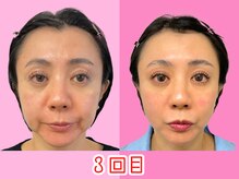 ナチュラルパーフェクトフェイス 新宿/３回目頬肉スッキリ新宿小顔矯正