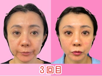 ナチュラルパーフェクトフェイス 新宿/３回目頬肉スッキリ新宿小顔矯正