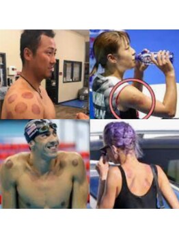 ほぐしガーデン 町田店/有名人中もカッピングが大人気!