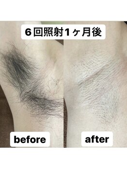 ココ(Coco)/ワキ脱毛