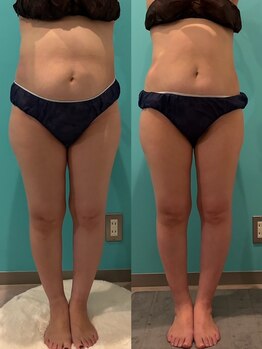 エステサロン 美飾り イオンモール木更津店/before⇒after/全身痩せ