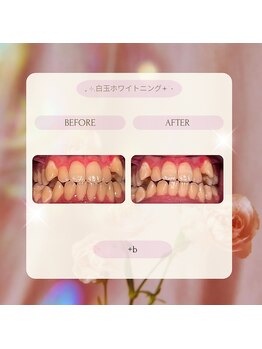 プラスビーセルフ(+b self)/ホワイトニングビフォーアフター