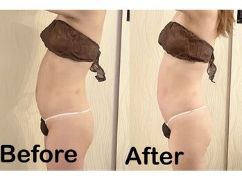 チェイル(JEIL)/高周波カッピング×コルギ